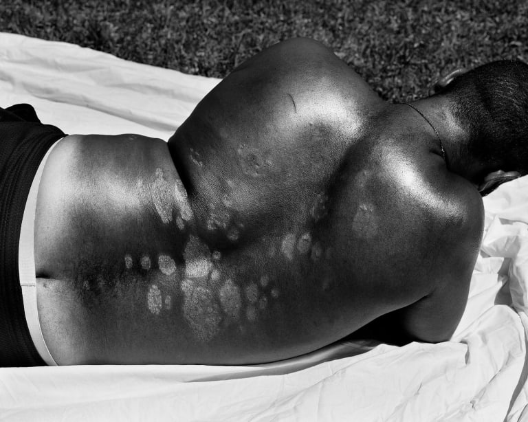 A horizontal black and white photograph of the back of a man lying on a white sheet in the grass. His skin is dark, except for a few patches and his pants and underwear are low, revealing a tan line. 
