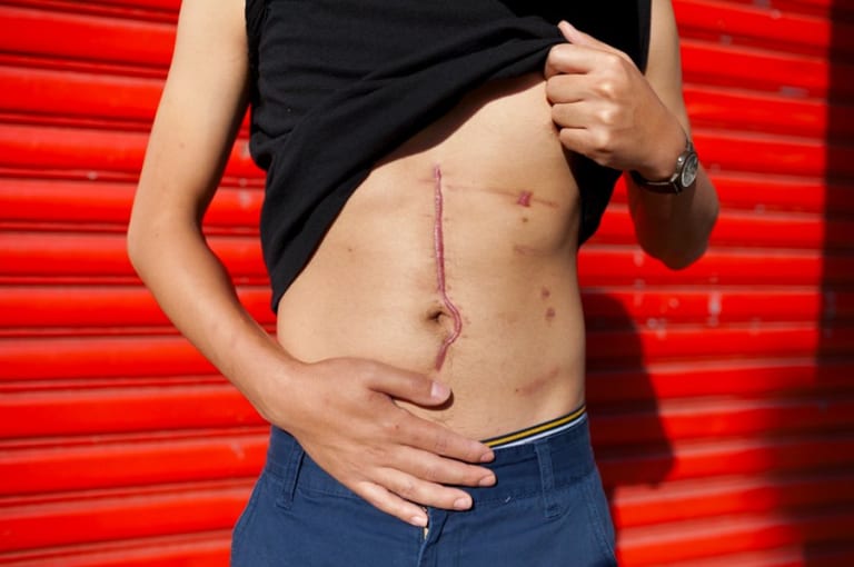 abdomen scar